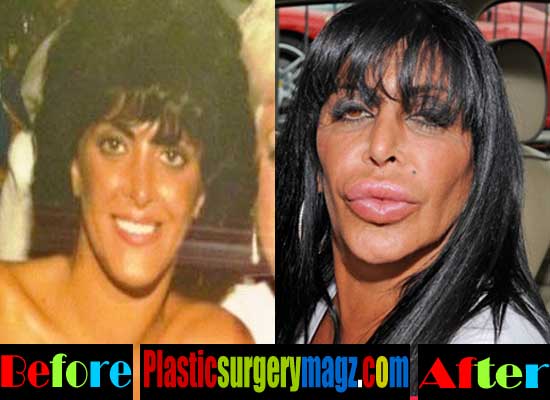 Big Ang Plastische Chirurgie Vorher Und Nachher ~ Berühmtheit 