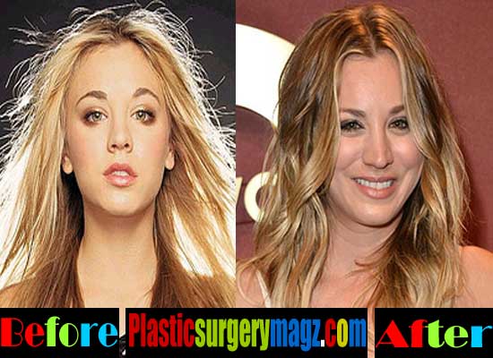 Kaley Cuoco Plastic Surgery Before And After Photos Plastic Surgery Magazine