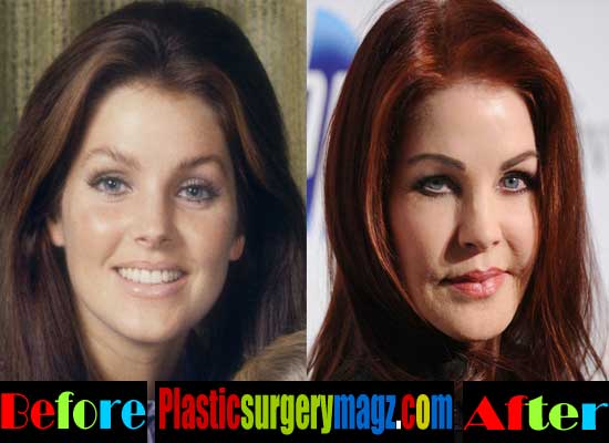 Priscilla Presley Plastic Surgery Disaster Plastic Surgery Magazine 