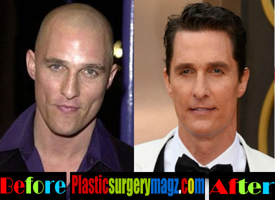 Matthew Mcconaughey Hair Before And After