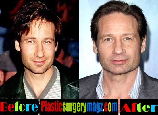 David Duchovny Plastic Surgery Before and After | | Plastic Surgery