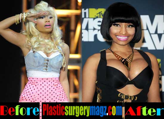 minaj nicki before implants breast surgery plastic boob job