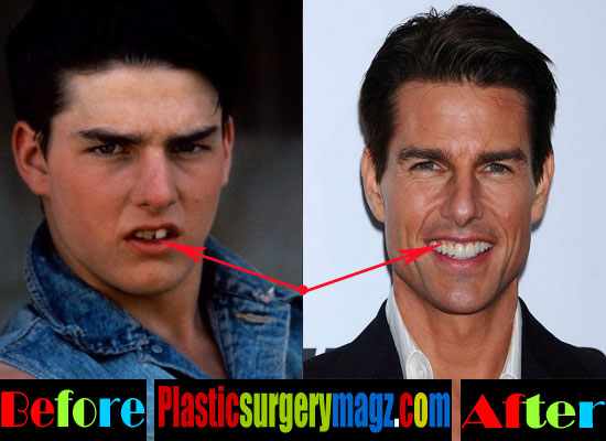 Tom Cruise Face Swap | Tom Cruise Face Lift, Nose Job, Teeth Surgery