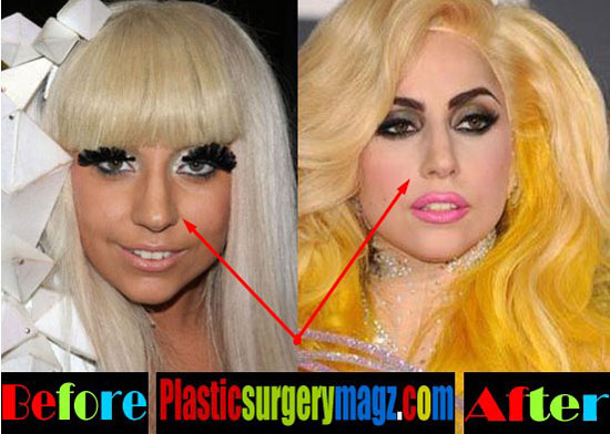 Lady Gaga Plastic Surgery Before After Lady Gaga Surgery 2016 Plastic Surgery Magazine 