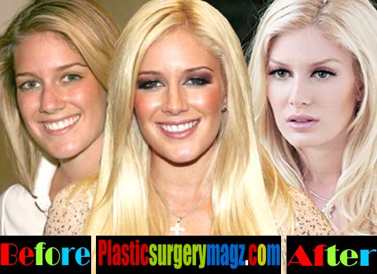 Heidi Montag Before Plastic Surgery