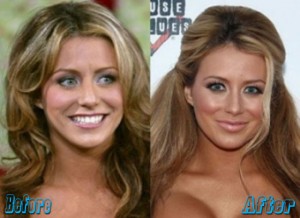 Aubrey O Day Plastic Surgery Before and After - Plastic Surgery Magazine