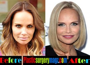 Kristin Chenoweth Plastic Surgery Before and After - Plastic Surgery