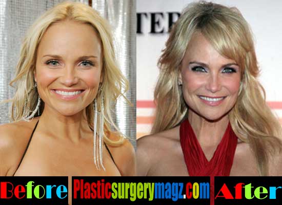 Kristin Chenoweth Plastic Surgery Before and After. 