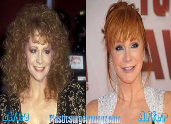 Reba Mcentire Plastic Surgery Before and After | | Plastic Surgery Magazine