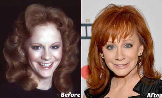 Reba Mcentire Plastic Surgery Before and After | Plastic Surgery Magazine