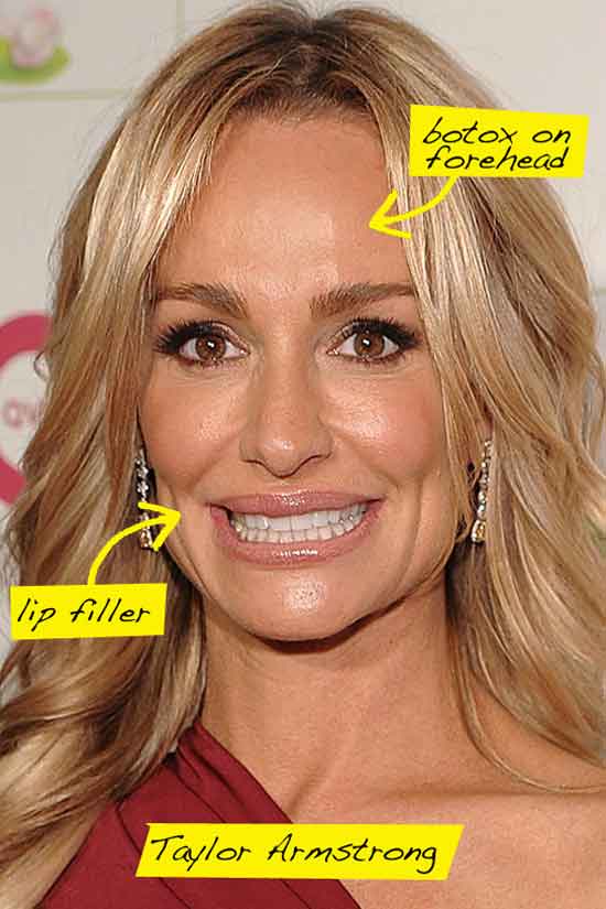 Taylor Armstrong Plastic Surgery Before and After ...