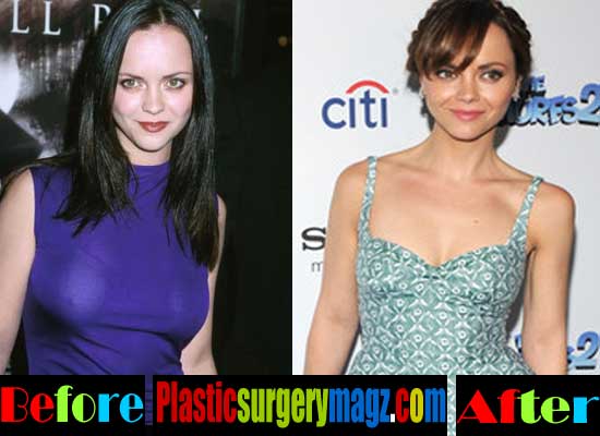 Christina Ricci Breast Reduction Before and After.