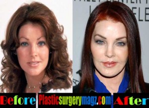 Priscilla Presley Plastic Surgery Disaster | Plastic Surgery Magazine