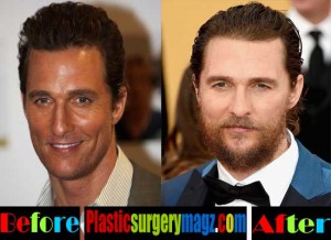 Matthew Mcconaughey Before and After Plastic Surgery | Plastic Surgery ...