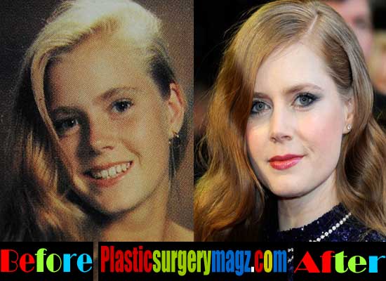 Amy Adams Plastic Surgery Before and After.
