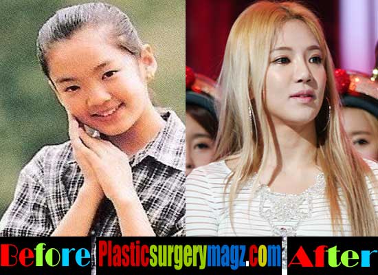 Hyoyeon Girls Generation Plastic Surgery | Plastic Surgery Magazine