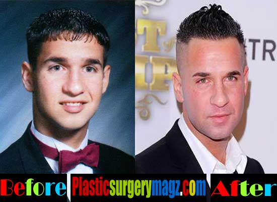 Mike the Situation Plastic Surgery Nose