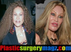 The Catwoman Plastic Surgery Before and After Pictures | Plastic ...