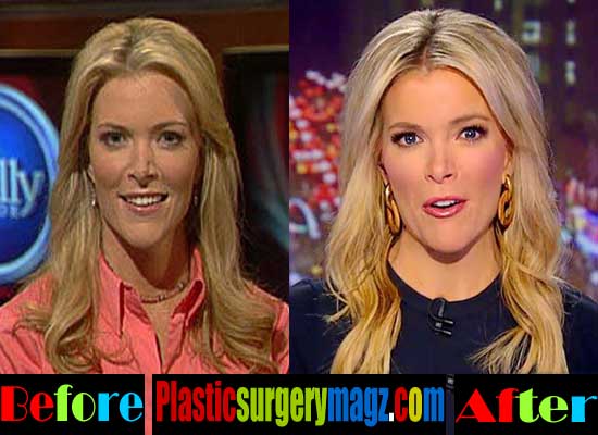 Megyn Kelly Plastic Surgery Before and After Photos | Plastic Surgery