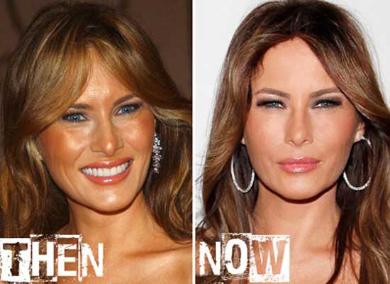 Melania Trump Plastic Surgery Before and After Pictures 