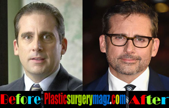 Steve Carell Plastic Surgery Hair Restoration.