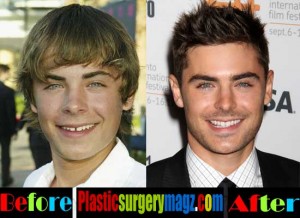 Zac Efron Before and Now | Plastic Surgery Magazine
