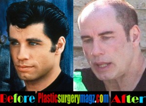 John Travolta Plastic Surgery | John Travolta Face Plastic - Plastic