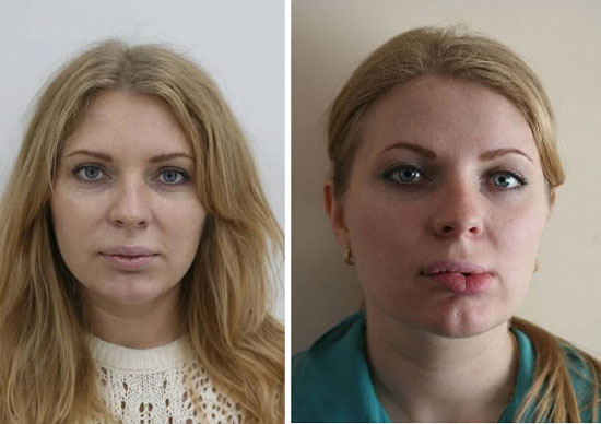  botox lip pop before and after 