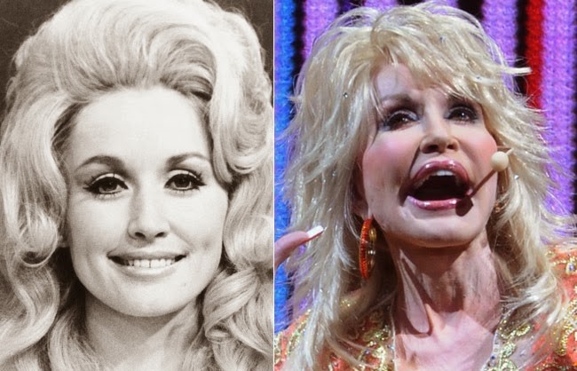 Dolly Parton Breast Implants - Before and After Pictures ...