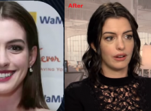 Anne Hathaway Nose Job