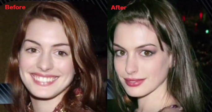 Anne Hathaway Nose Job – Before and After | Plastic Surgery Magazine