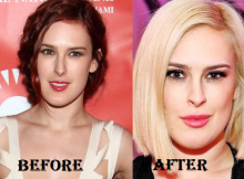 Rumer Willis Plastic Surgery
