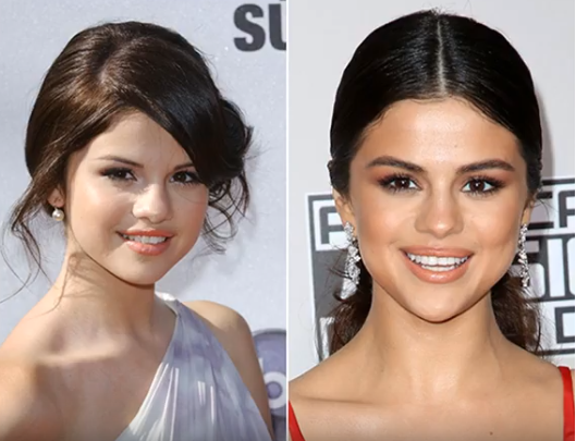 Selena Gomez Plastic Surgery Transformation Plastic Surgery Magazine