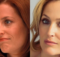 gillian andersons Eyelid Surgery
