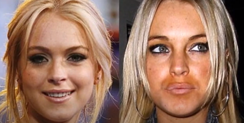 Lindsay Lohan Plastic Surgery – how well did it go? | Plastic Surgery ...