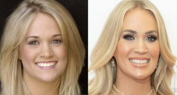 Public Reactions to Carrie Underwood's Plastic Surgery Choices