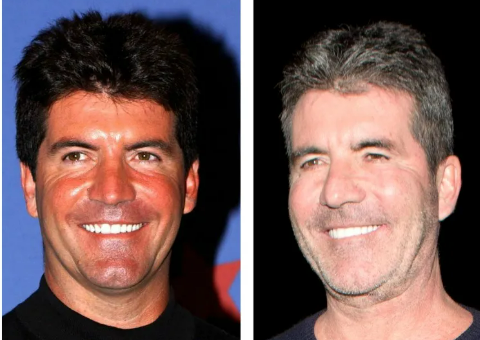 Understanding the Reasons Behind Simon Cowell's Surgery Choices