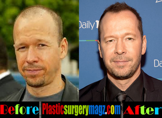 Unveiling Donnie Wahlberg's Plastic Surgery Rumors: Truth vs. Fiction
