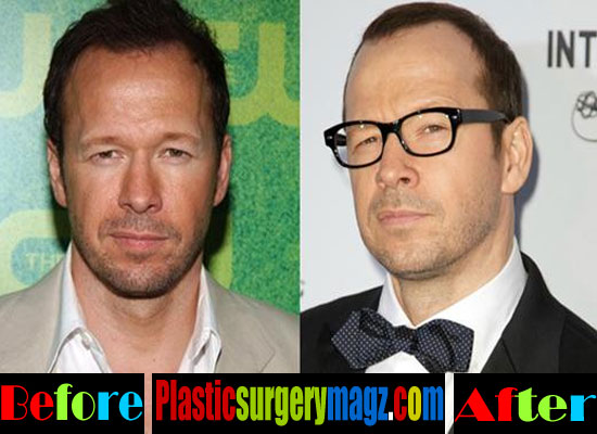 Celebrity Influence: Donnie Wahlberg's Impact on Plastic Surgery Trends